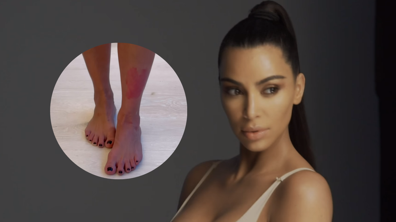 Kim Kardashian Shares Inside Look At Her Psoriasis Journey [photos] Enstarz